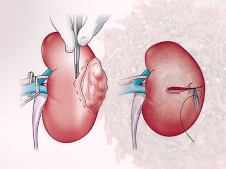 Kidney Hospital in Shahibaug Ahmedabad  
